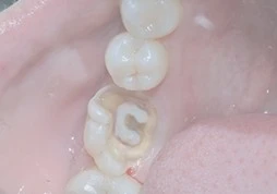 珠海根管治療推薦