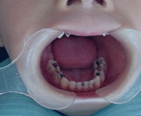 牙髓炎治療價錢