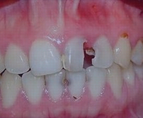 牙髓炎治療收費