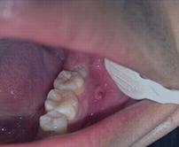 牙髓炎治療推介
