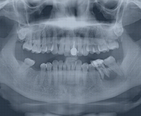 牙髓炎治療幾錢