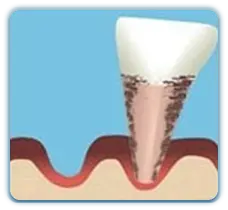 珠海牙周炎治療費用