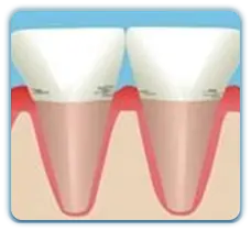 珠海牙周病治療推介
