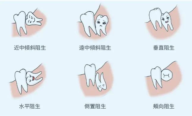 拱北拔智慧齒