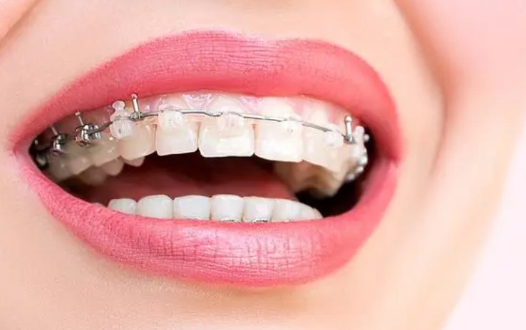 牙齿矫正1